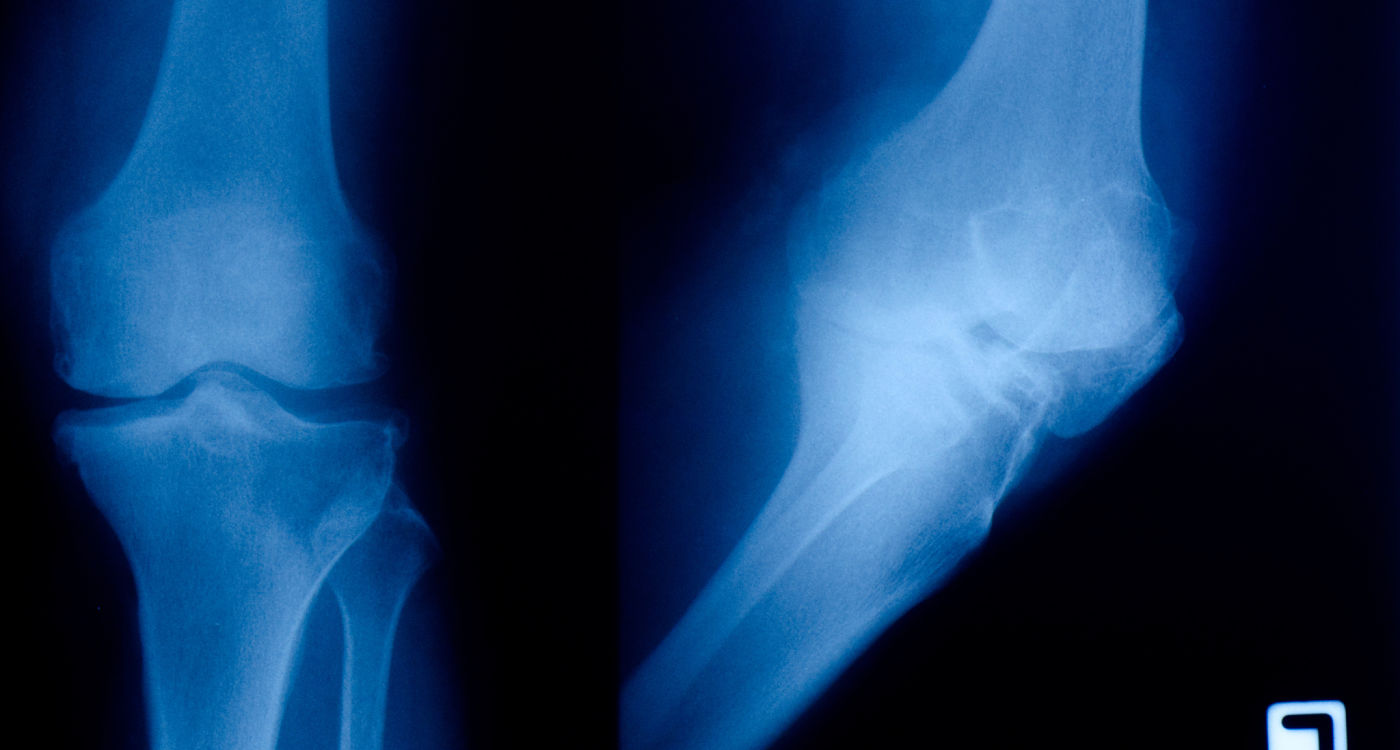 Oxford osteoarthritis patients in new clinical trial University of Oxford