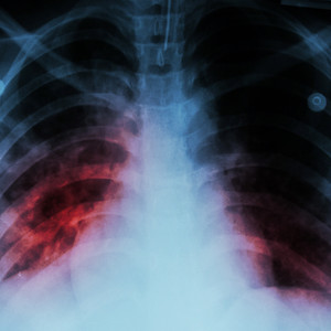 Biomarker discovery offers hope for new TB vaccine