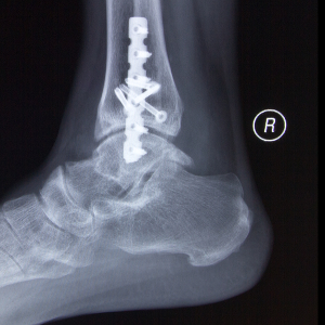 Elderly patients with unstable ankle fractures could avoid surgery