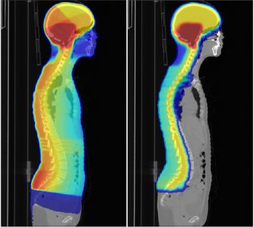 Proton therapy (right) can reduce radiation dose to healthy tissues compared with standard radiotherapy (left).