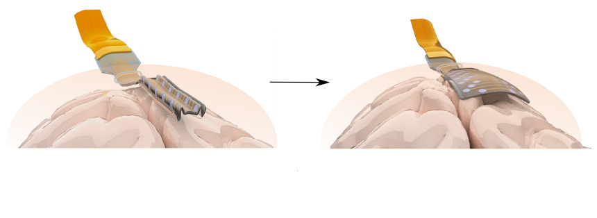 An electrode folded, concertina-like over the surface of the brain. Next panel shows the electrode unfolded, so that it covers a much larger surface area. 