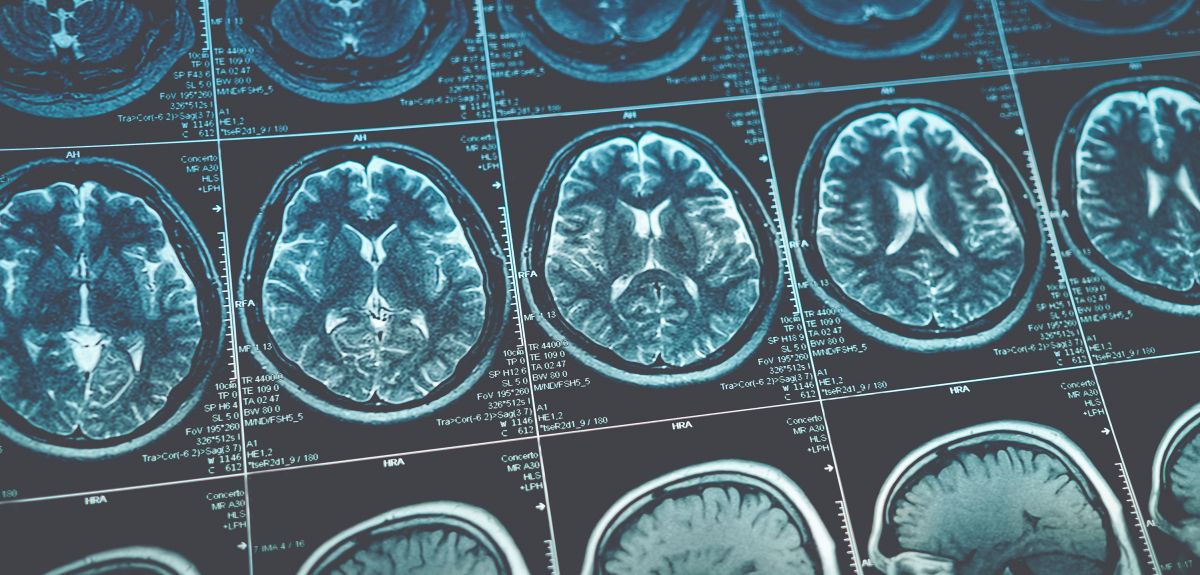 Oxford spinout to diagnose Alzheimer’s Disease from MRI scans