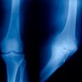 Xray showing Right Knee Osteoarthritis