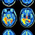 First genetic analysis of brain function and structure using UK Biobank imaging data yields exciting results 